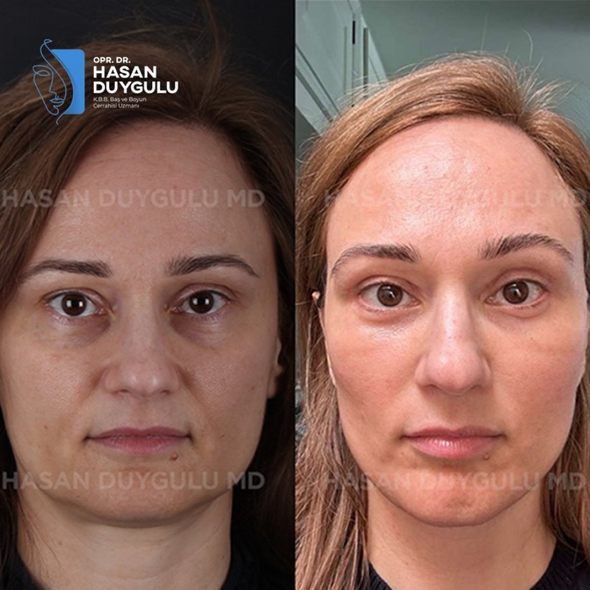 Resultados de rinoplastia antes y después en Dr. Hasan Duygulu Private Practice, remodelación nasal