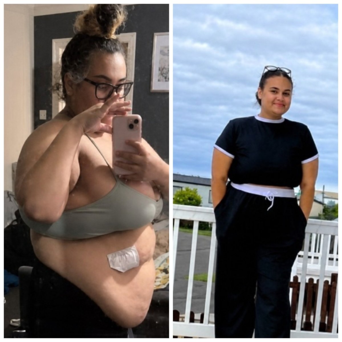 Resultados antes y después de manga gástrica en la clínica Dr. Islam Abdelkhalek, pérdida de peso visible
