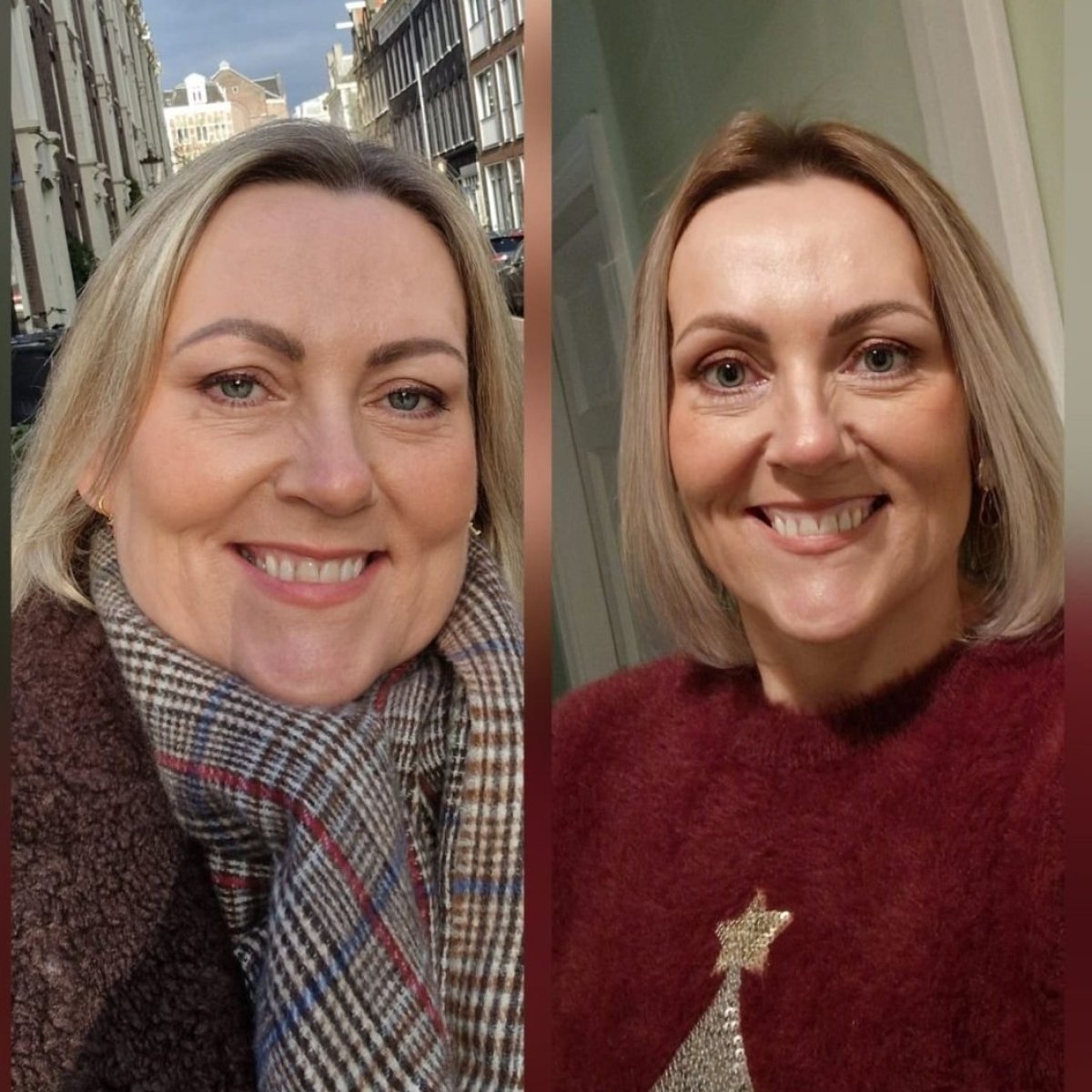 Antes y después de bypass gástrico Roux-en-Y en la clínica Dr. Islam Abdelkhalek, resultado visible