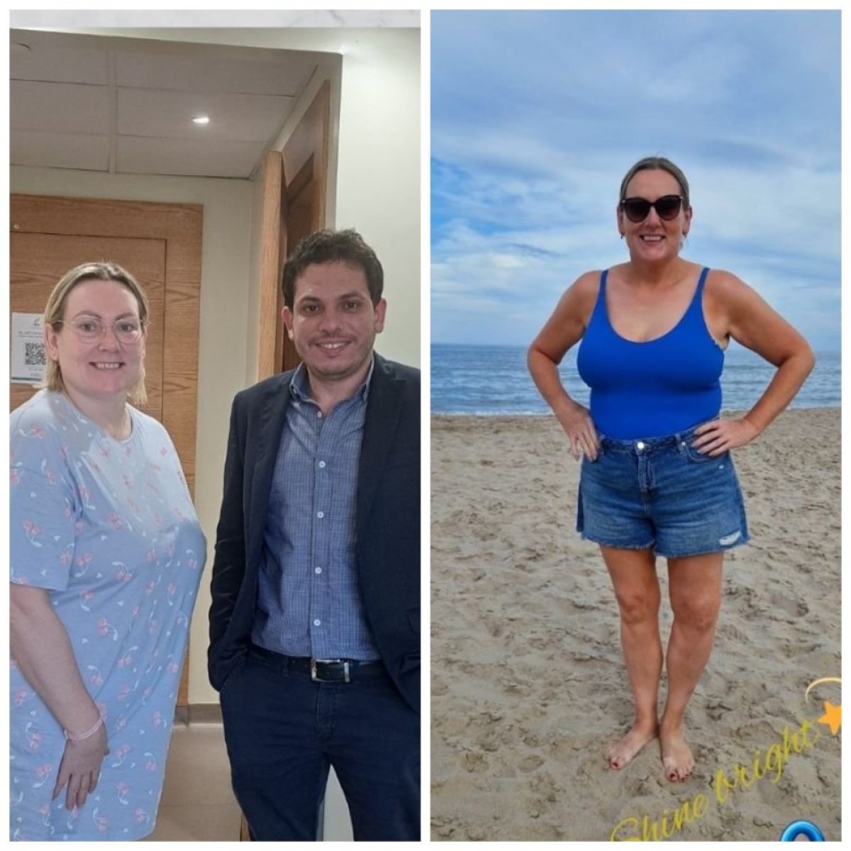 Antes y después de bypass gástrico Roux-en-Y en la clínica Dr. Islam Abdelkhalek, resultado de pérdida de peso