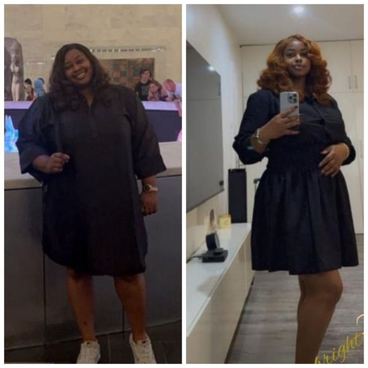 Antes y después de bypass gástrico Roux-en-Y en la clínica Dr. Islam Abdelkhalek, resultado visible
