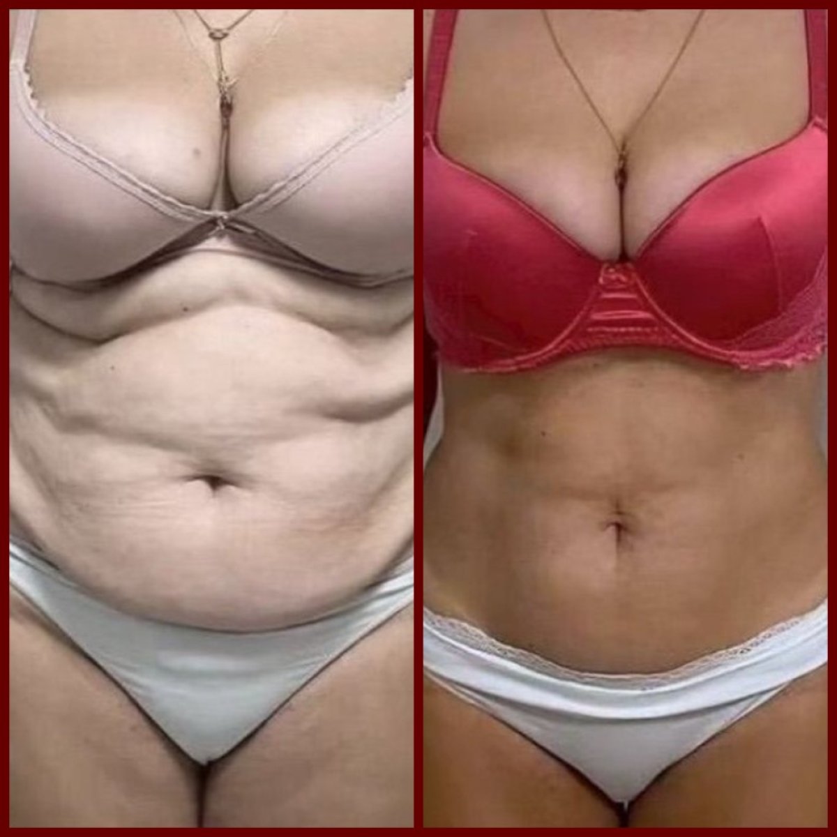 Resultados antes y después de Vaser liposucción en DGB Clinic – contorno abdominal mejorado