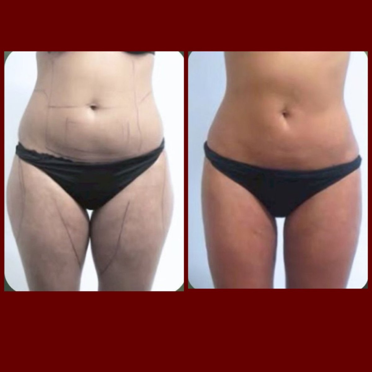 Before and after Vaser liposuction results at DGB Clinic, body contouring improvement