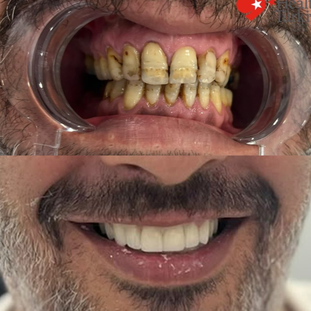 نتائج زراعة الأسنان قبل وبعد في BETADENT — Betadent Ağız ve Diş Sağlığı Polikliniği