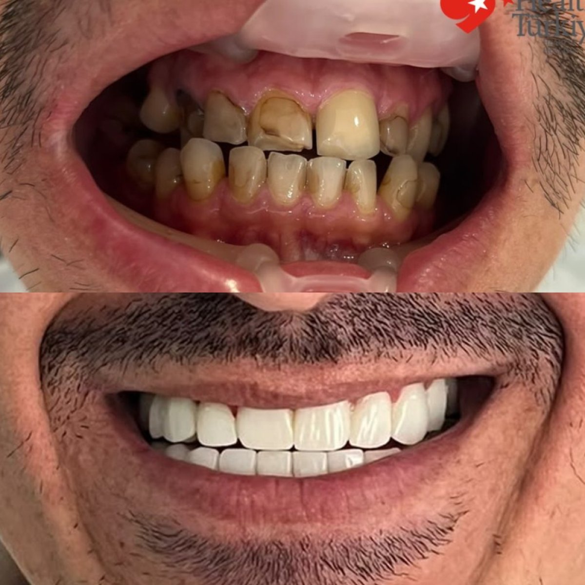 نتائج قبل وبعد زراعة الأسنان في BETADENT — Betadent Ağız ve Diş Sağlığı Polikliniği