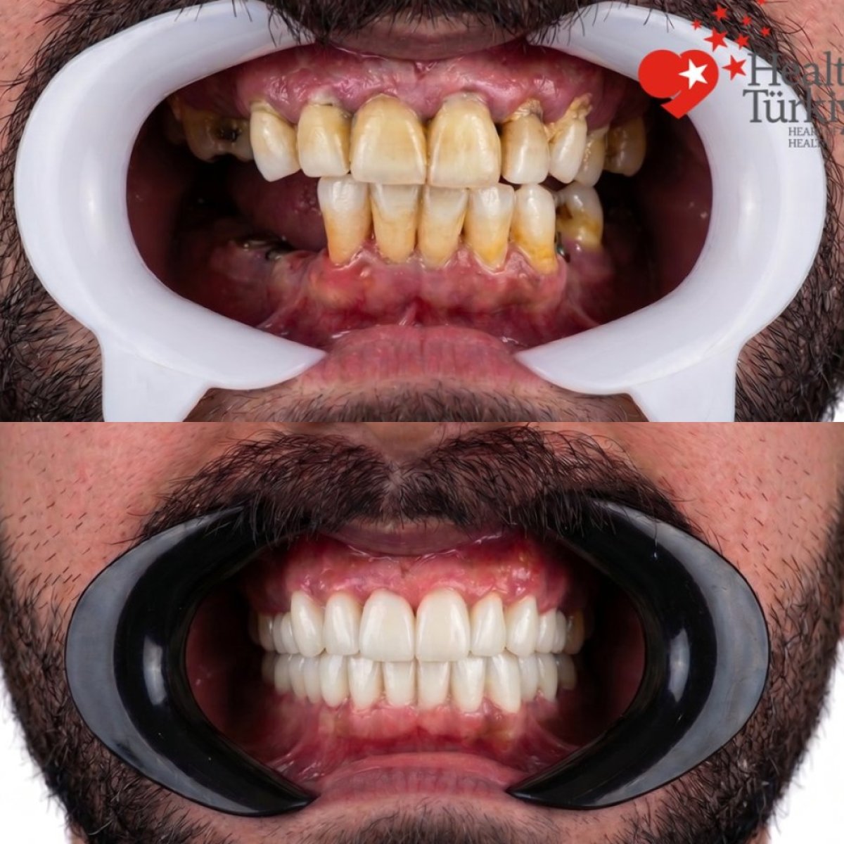 نتائج قبل وبعد زراعة الأسنان في BETADENT — Betadent Ağız ve Diş Sağlığı Polikliniği