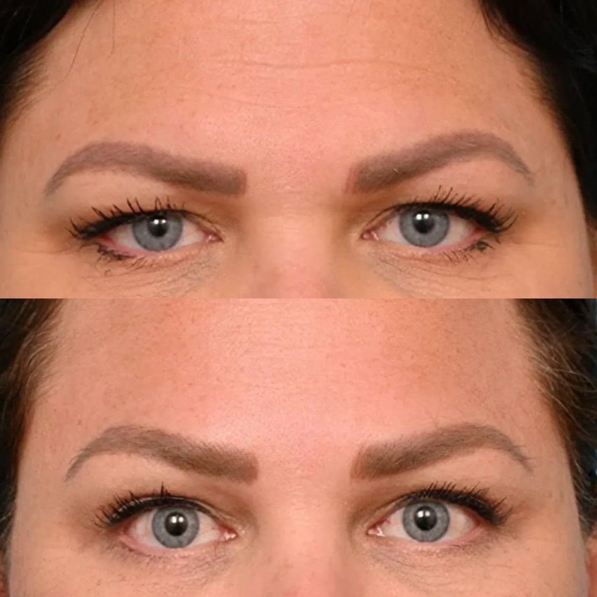 Before and after brow lift results at Dr. Alexandro Aguilera - Plastic Surgery, lifted brows