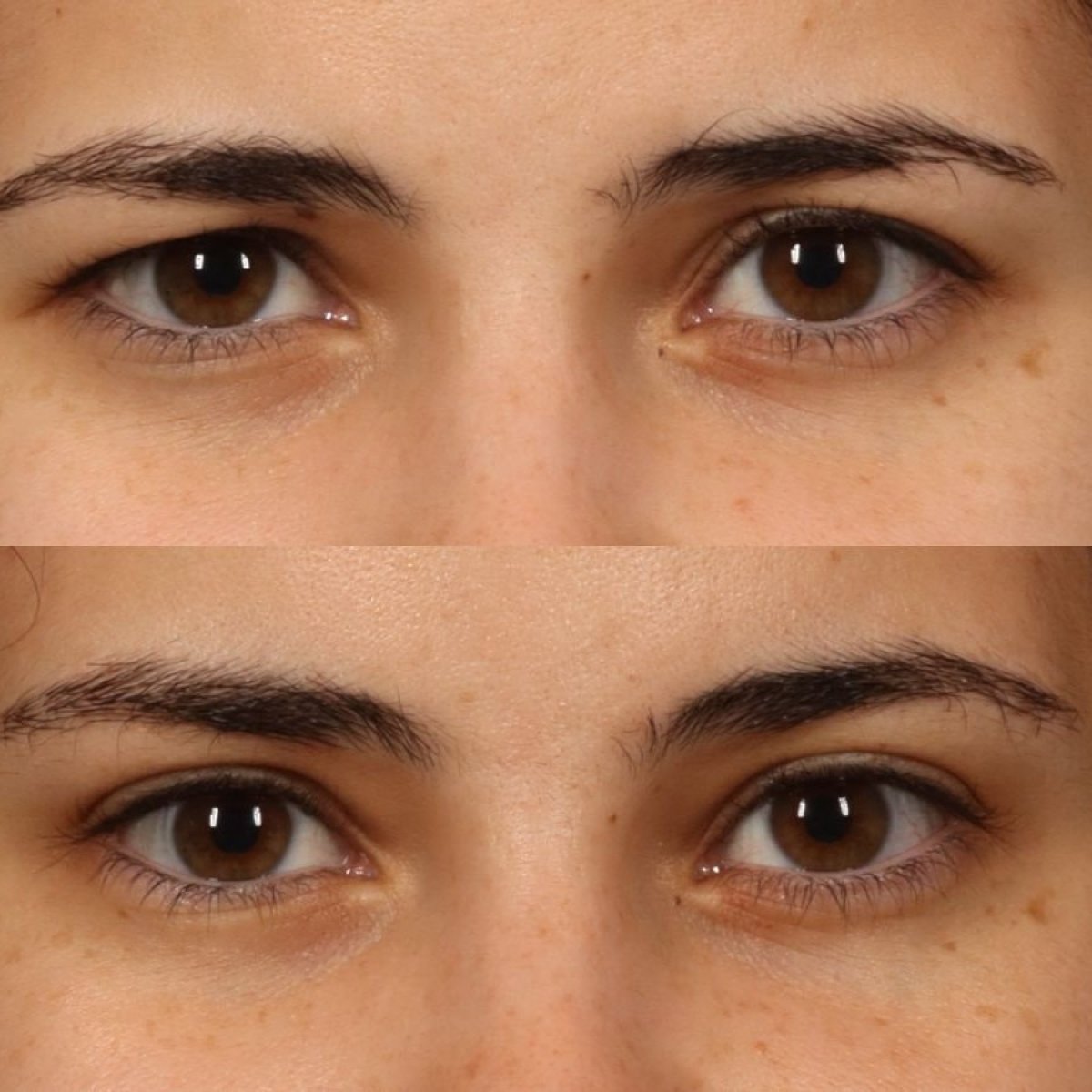 Before and after brow lift results at Dr. Alexandro Aguilera - Plastic Surgery, eye area rejuvenation