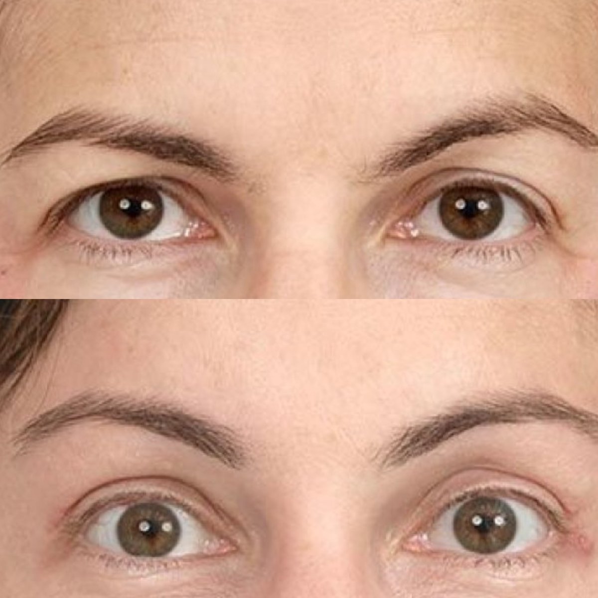 Resultados antes y después de lifting de cejas en Dr. Alexandro Aguilera - Plastic Surgery