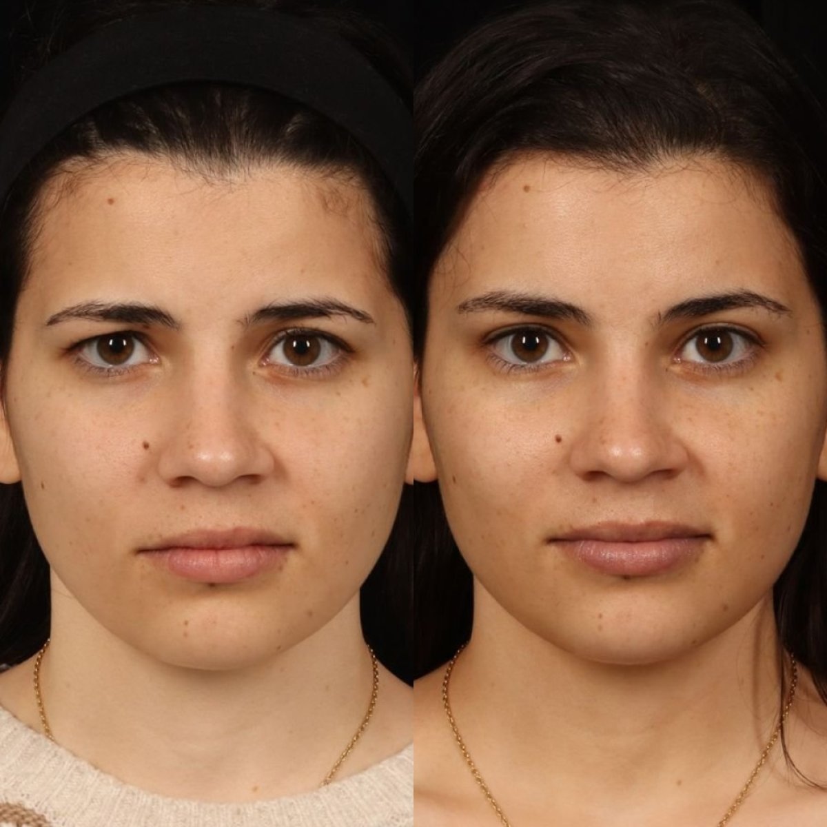 Resultados antes y después de lifting de cejas en Dr. Alexandro Aguilera - Plastic Surgery