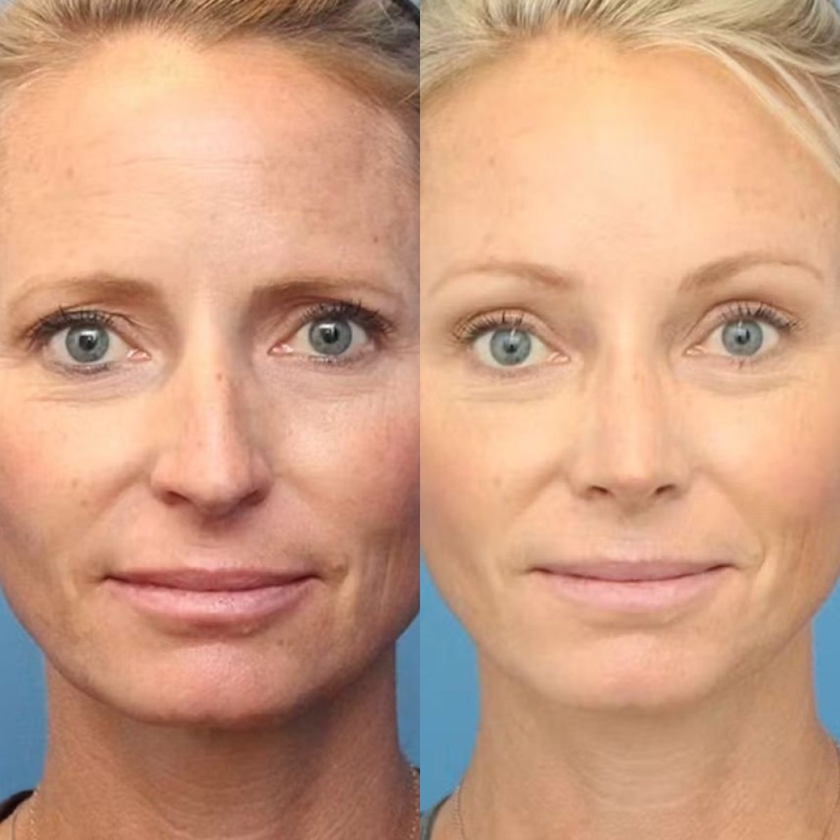 Resultados antes y después de lifting de cejas en Dr. Alexandro Aguilera - Plastic Surgery