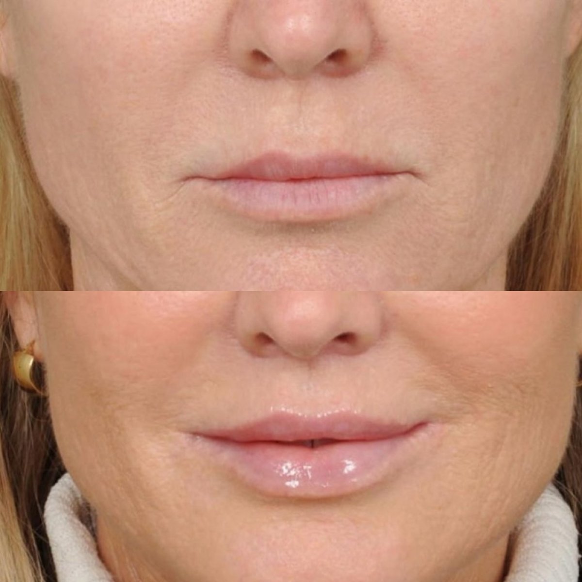 نتائج قبل وبعد رفع الشفاه في Dr. Alexandro Aguilera - Plastic Surgery، تحديد الشفاه المحسن
