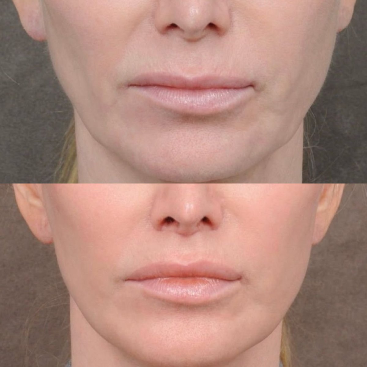 نتائج قبل وبعد رفع الشفاه في Dr. Alexandro Aguilera - Plastic Surgery، تحديد الشفاه المحسن