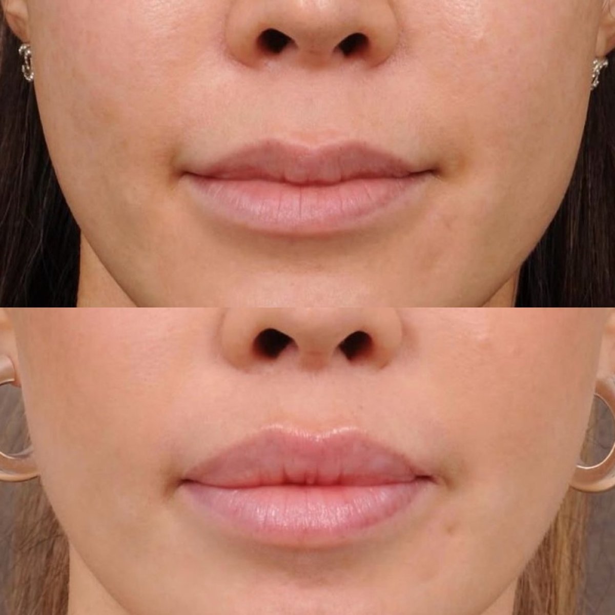 Результаты до и после лип лифтинга в Dr. Alexandro Aguilera - Plastic Surgery, улучшенный контур губ