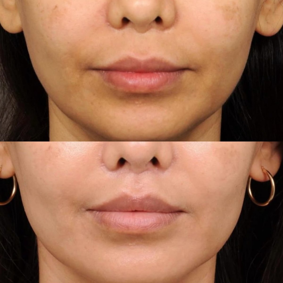 Результаты до и после лип лифтинга в Dr. Alexandro Aguilera - Plastic Surgery, улучшенный контур губ