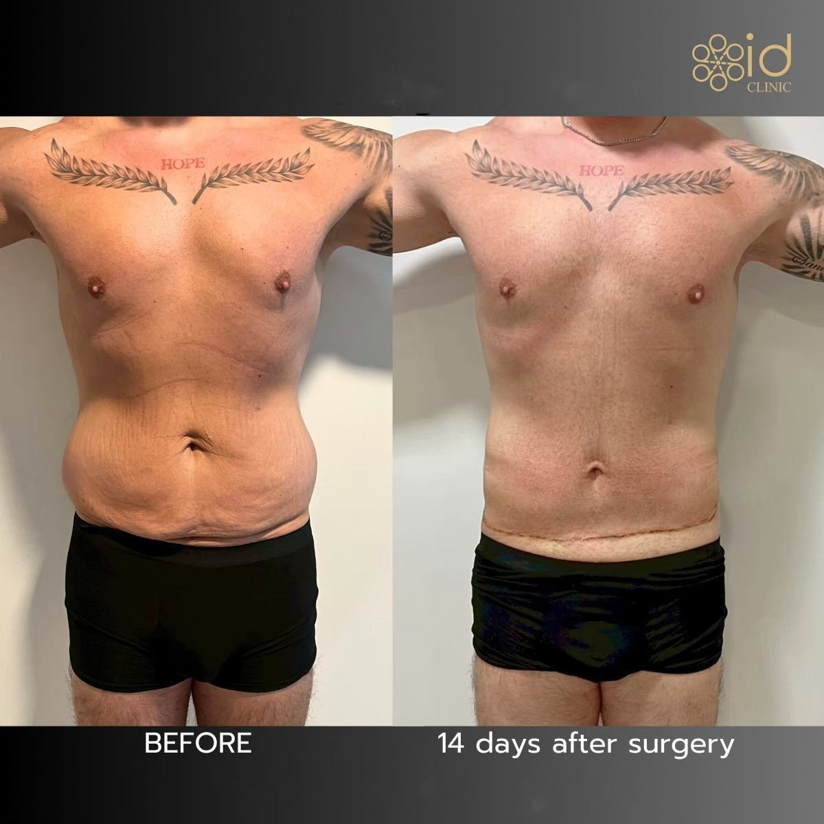 Resultados de abdominoplastia y liposucción en ID Clinic Bangkok, 14 días después