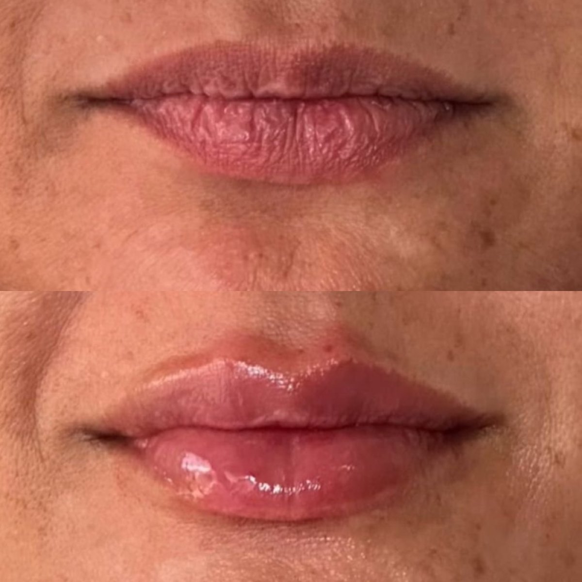 نتائج قبل وبعد فيلر الشفاه بحمض الهيالورونيك في Punta Cana dentist odontologia familiar