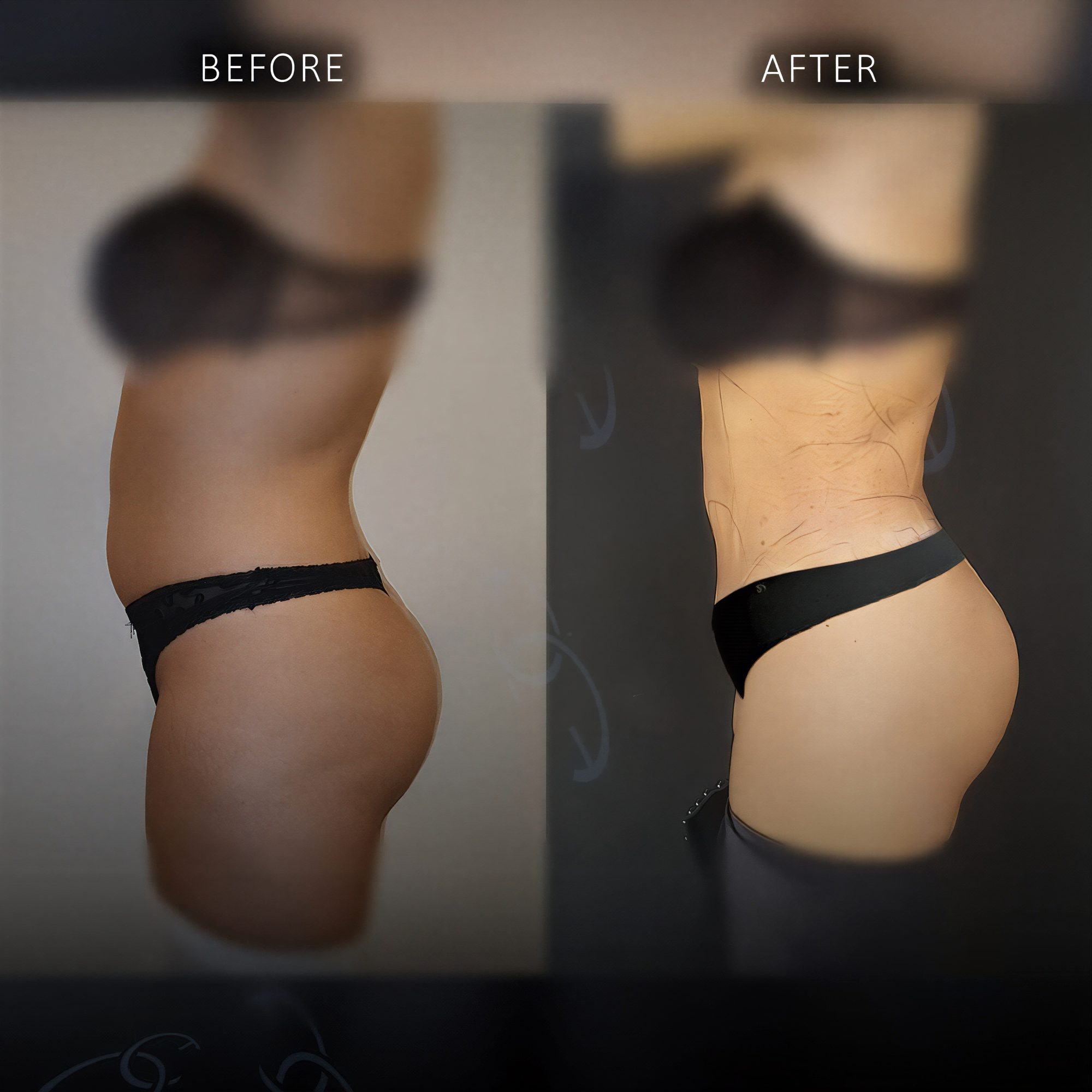 Resultados de liposucción 360 antes y después en Dr. Safa Manav Clinic, contorno visible