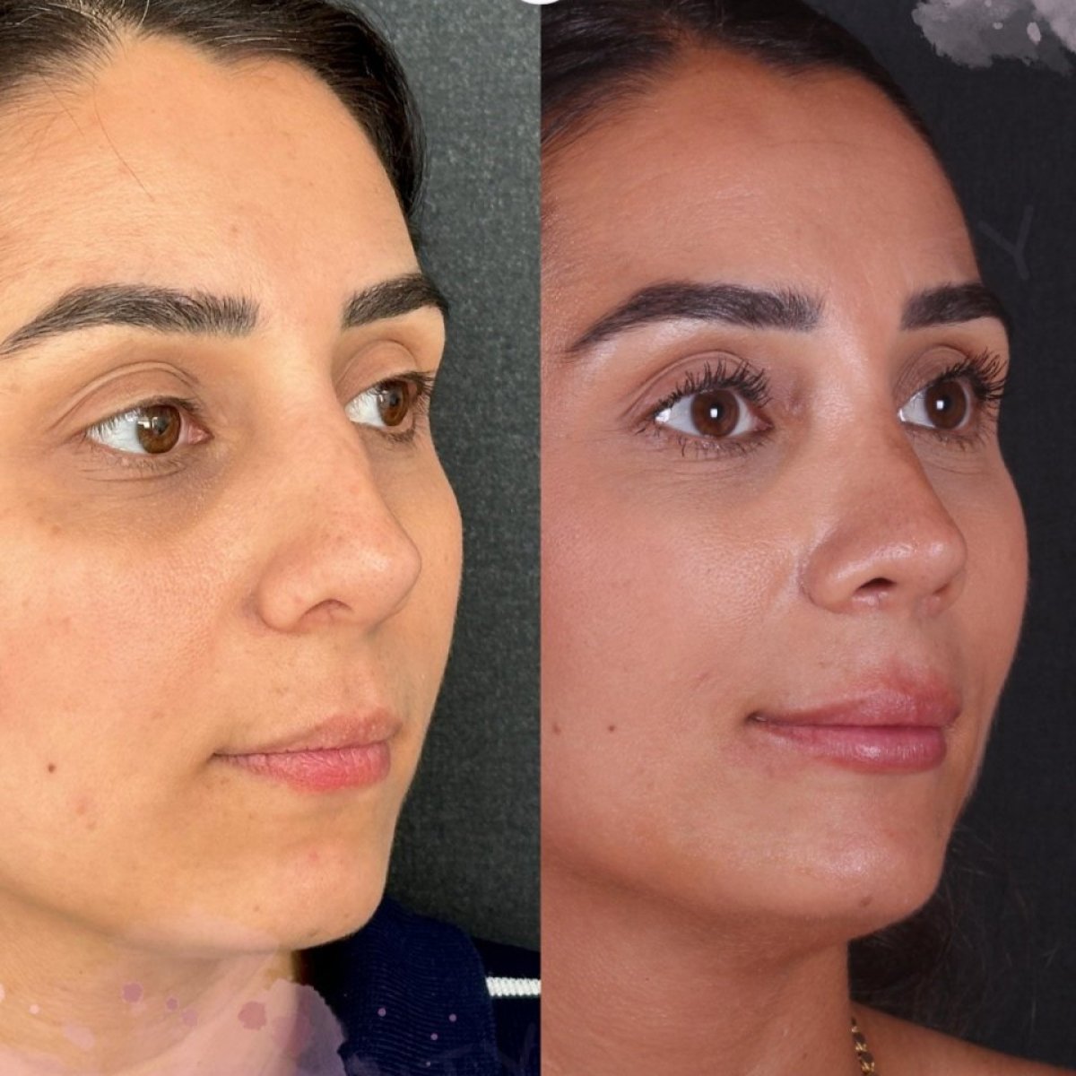 نتائج عملية تجميل الأنف قبل وبعد في Vanity Cosmetic Surgery Center، شكل أنف مصقول