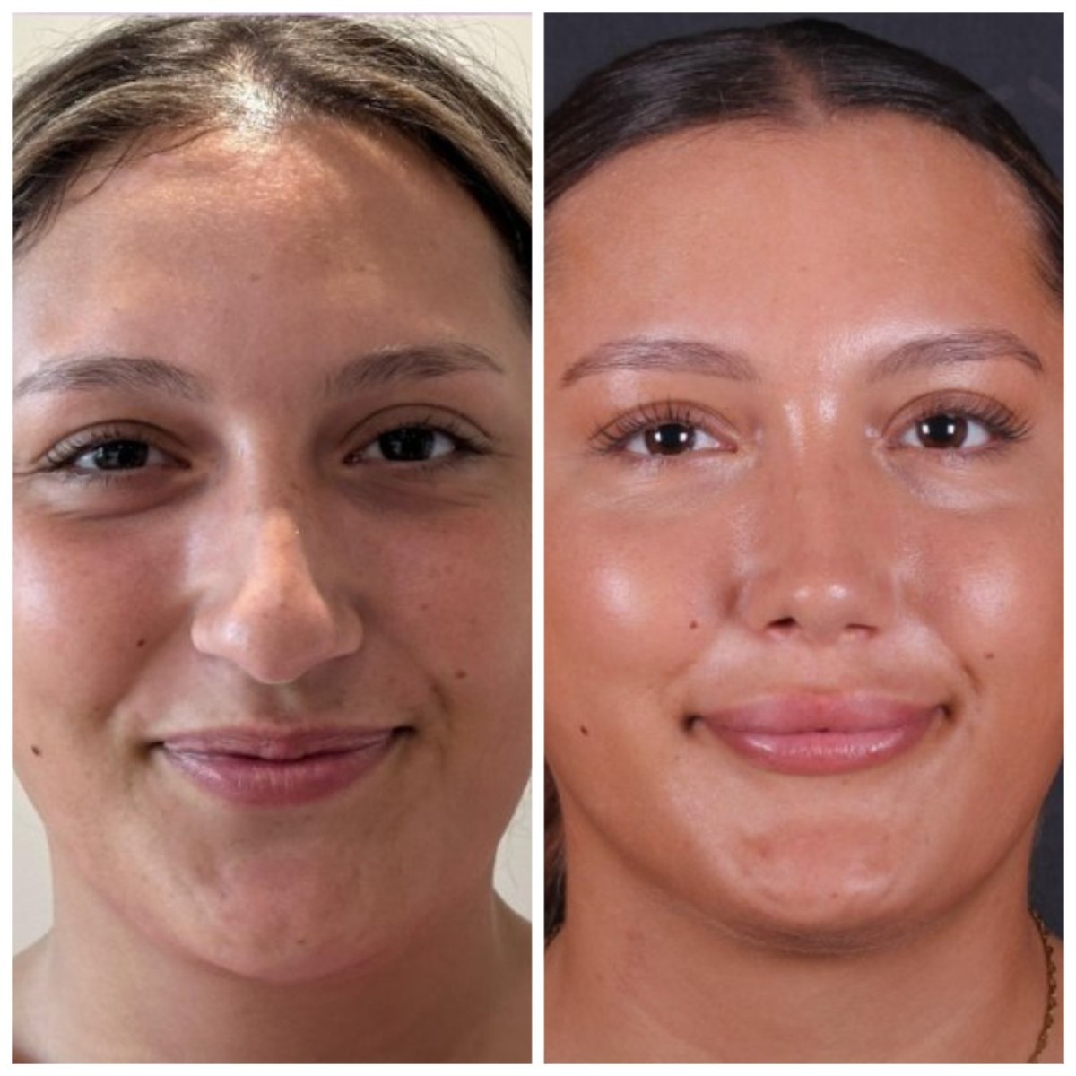 نتيجة عملية تجميل الأنف قبل وبعد في Vanity Cosmetic Surgery Center، إعادة تشكيل الأنف