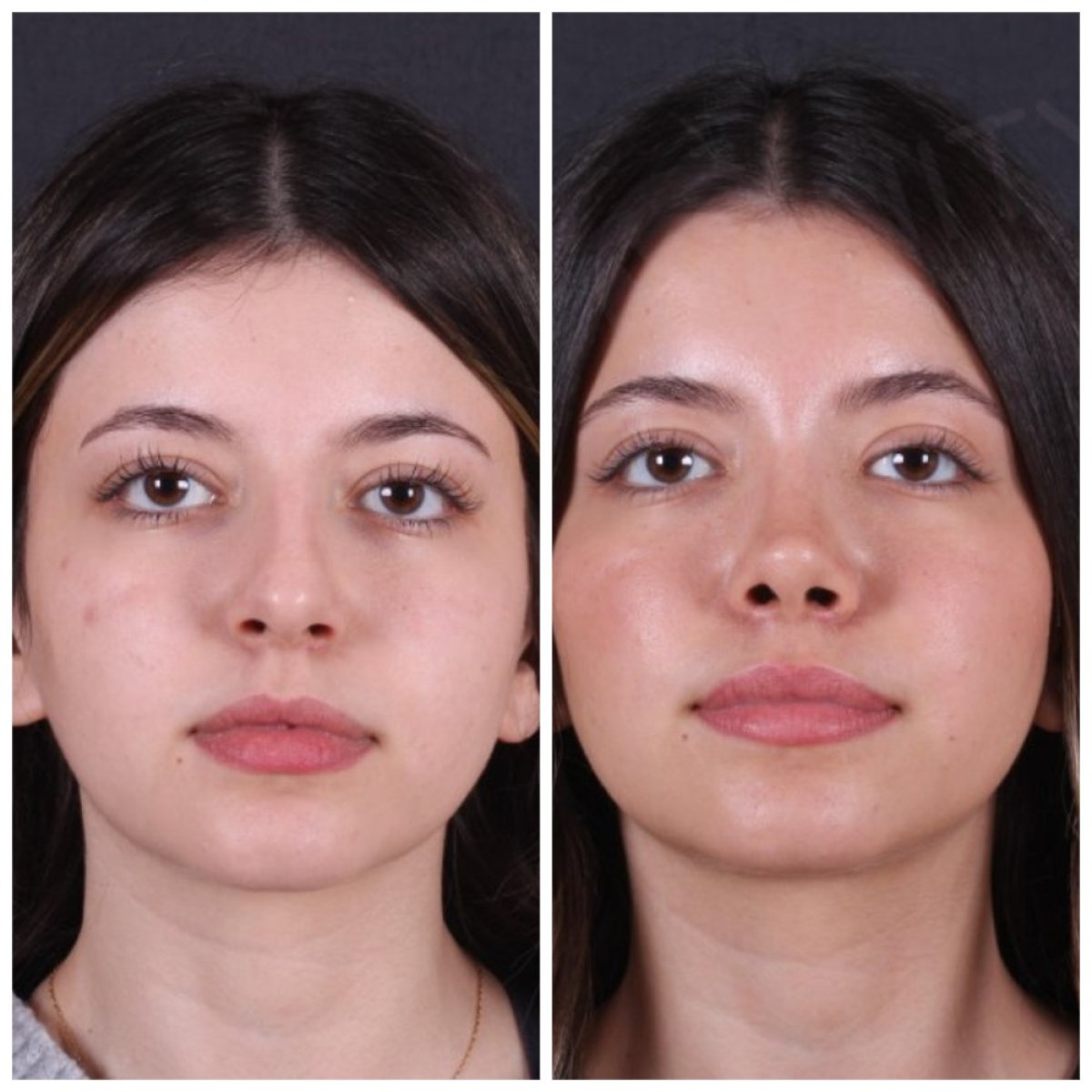 نتيجة تجميل الأنف قبل وبعد في Vanity Cosmetic Surgery Center، شكل أنف محسّن