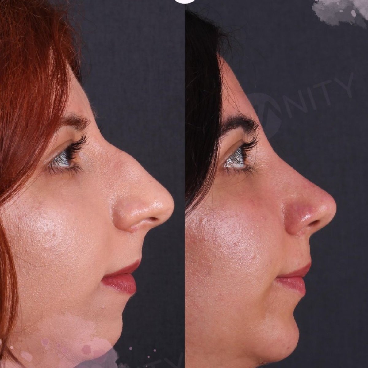 نتائج عملية تجميل الأنف قبل وبعد في Vanity Cosmetic Surgery Center، إعادة تشكيل الأنف