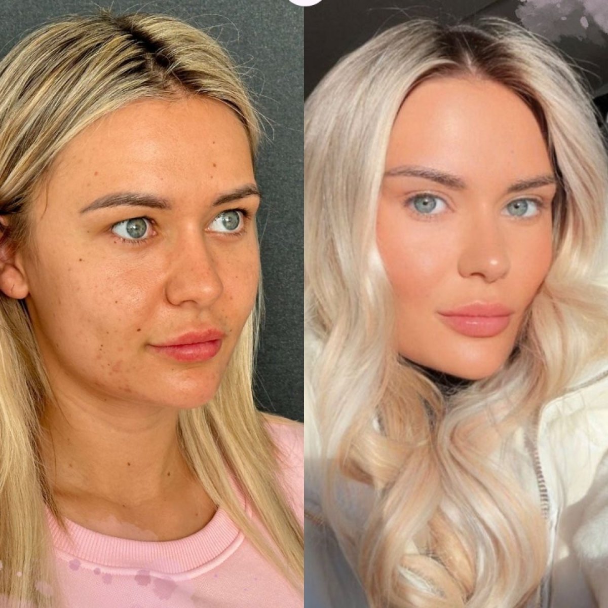 قبل وبعد عملية تجميل الأنف في Vanity Cosmetic Surgery Center، نتيجة إعادة تشكيل الأنف