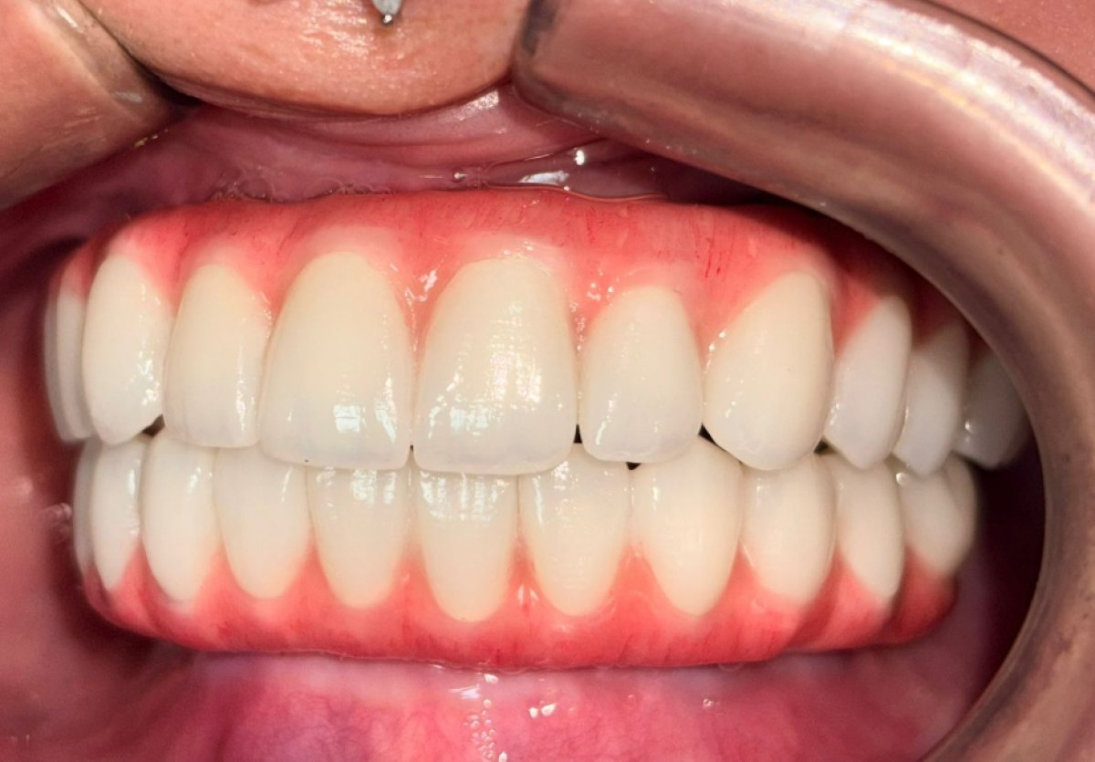 Efekt implantów All-on-4 w Dental 3 Smiles – pełny łuk z naturalnym wyglądem
