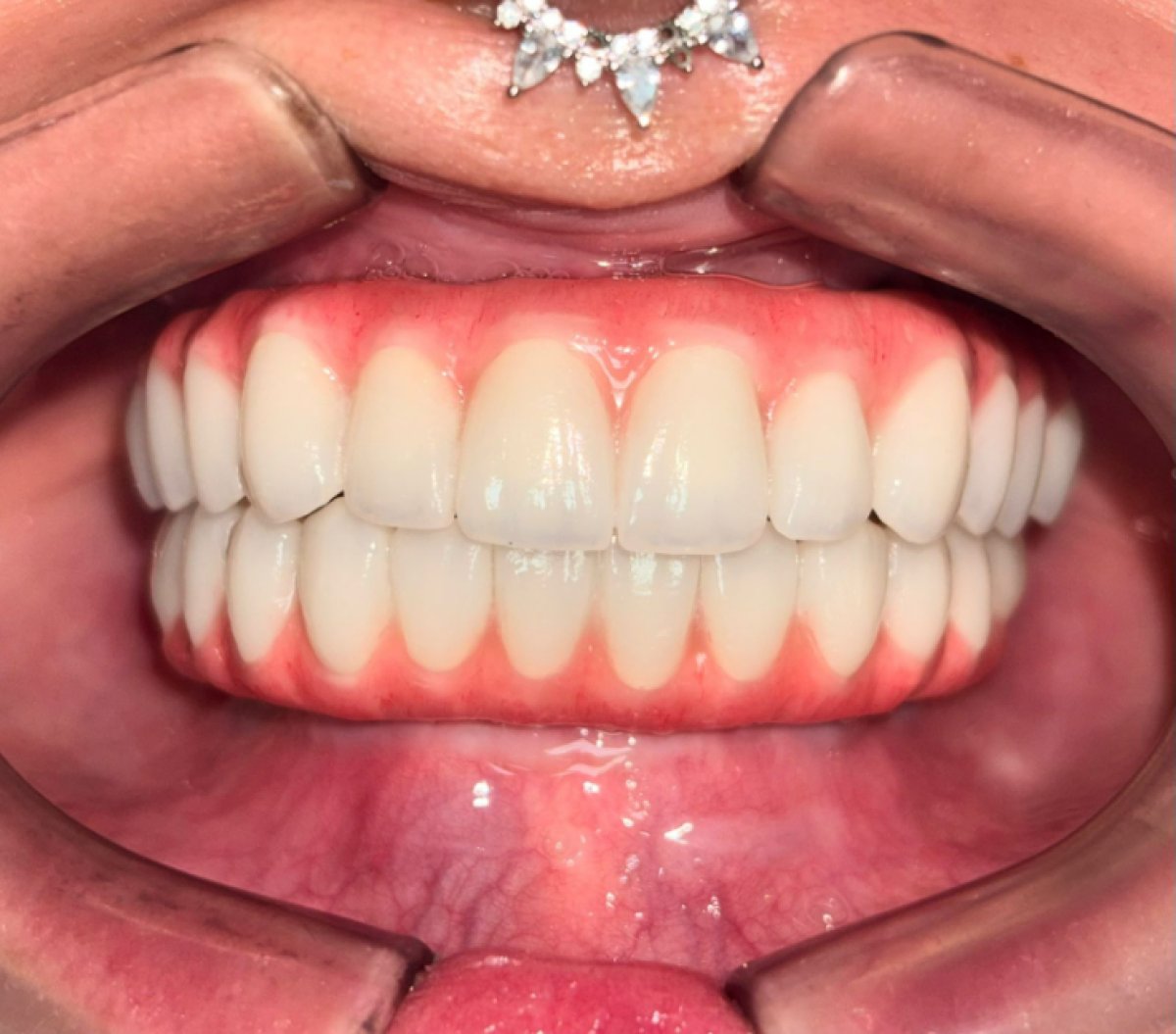 Efekt implantów All-on-4 w Dental 3 Smiles – pełna odbudowa łuku z naturalnym wyglądem