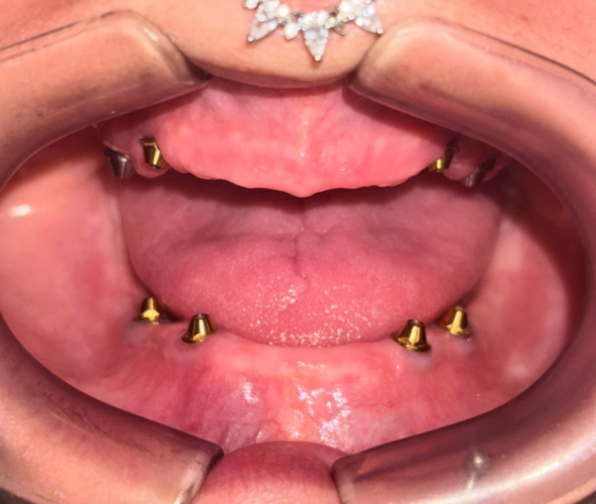 Resultado de implantes dentales All-on-4 en Dental 3 Smiles, vista de ambas mandíbulas