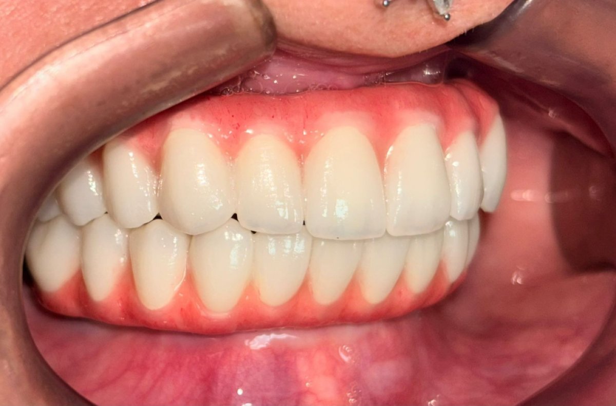 Resultado de implantes dentales All-on-4 en Dental 3 Smiles: arco restaurado y dientes naturales