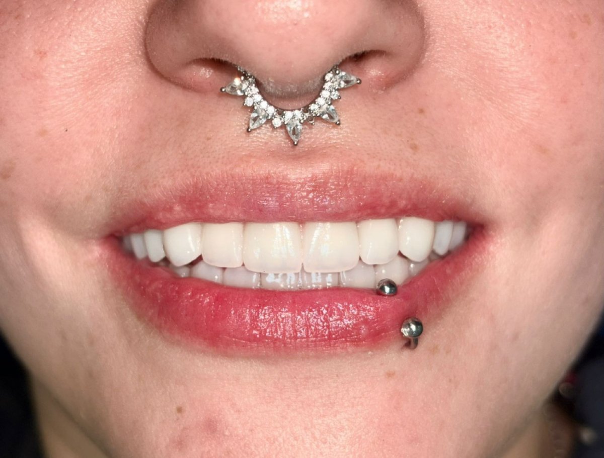 Transformación de sonrisa tras implantes All-on-4 en Dental 3 Smiles, resultado natural