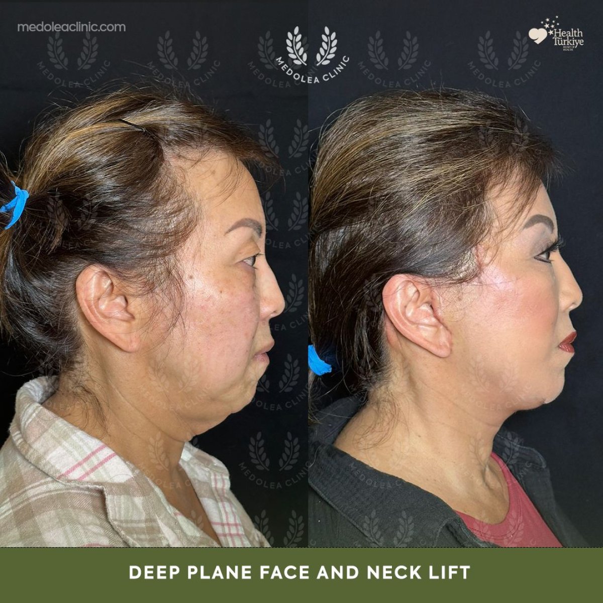 Результати до і після deep plane підтяжки обличчя та шиї в клініці Dr. Safa Manav