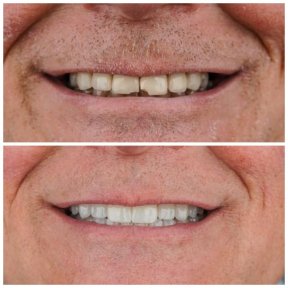 All-on-4 Neodent — Both Jaws, Fixed Teeth in 2 Visits - photo 6