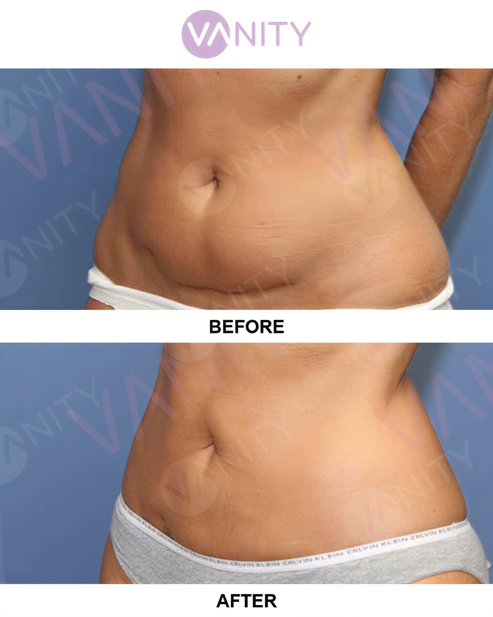 Resultados de liposucción antes y después en Vanity Cosmetic Surgery Center, abdomen mejorado