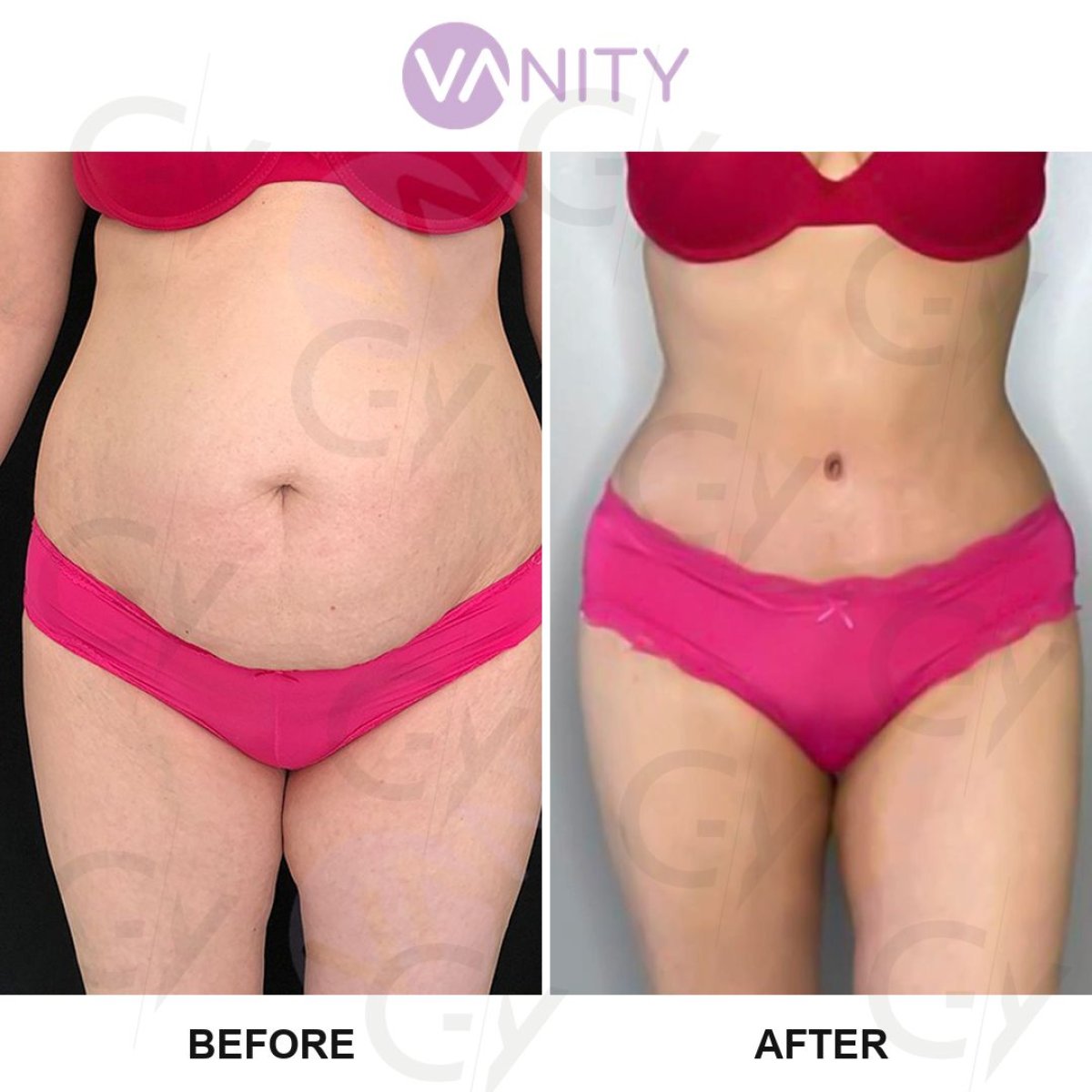 Resultados de liposucción antes y después en Vanity Cosmetic Surgery Center, mejor contorno corporal
