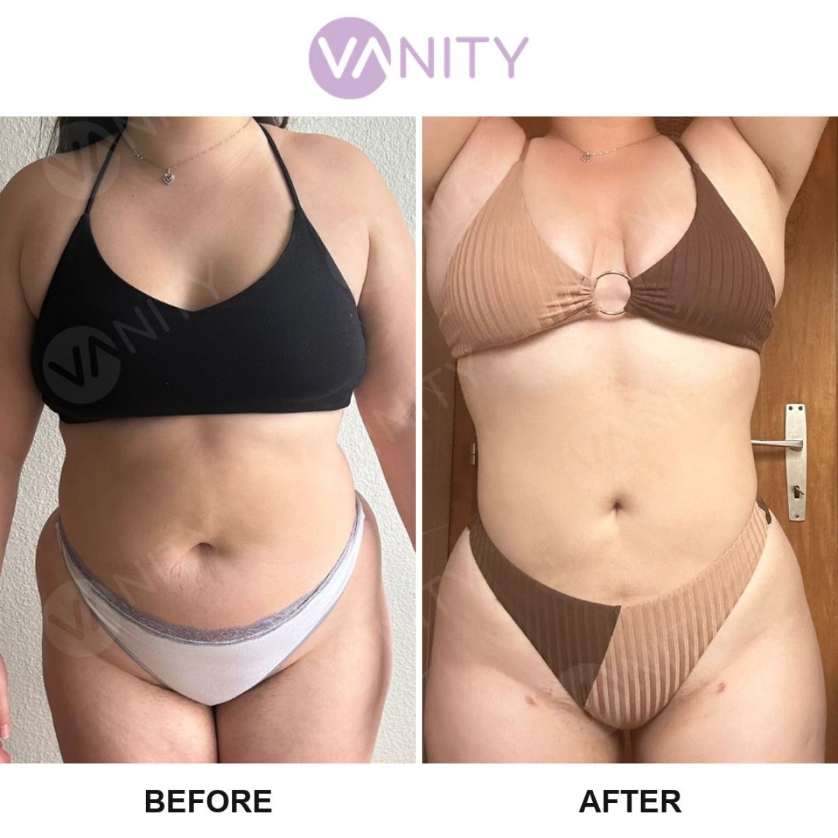 Resultados de liposucción antes y después en Vanity Cosmetic Surgery Center, mejor contorno corporal
