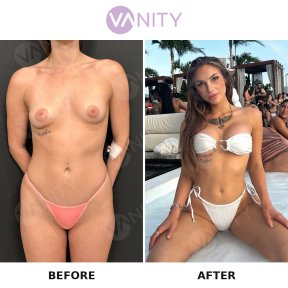 Standard Breast augmentation with Motiva® Ergonomix® breast implants - photo 6