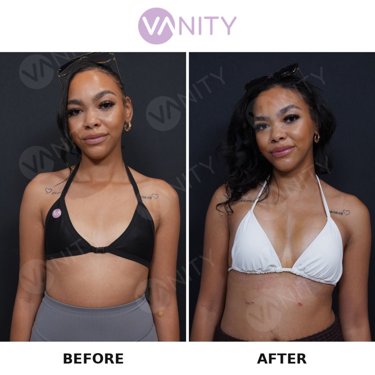 Resultados antes y después de aumento de senos en Vanity Cosmetic Surgery Center, mayor volumen
