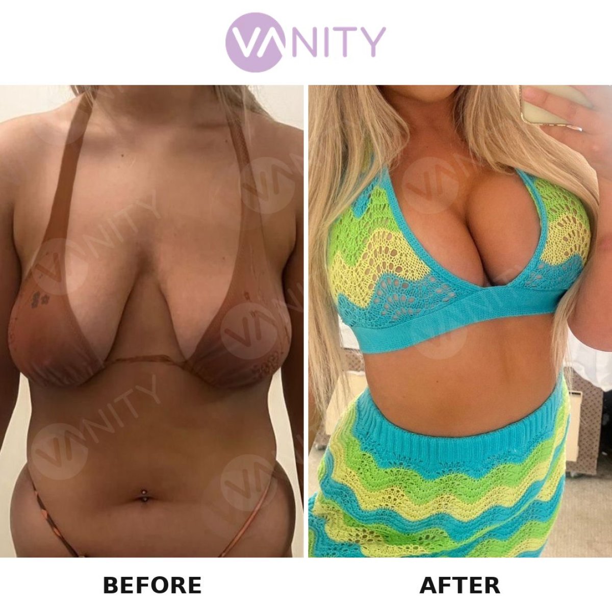 Resultados antes y después de aumento de senos en Vanity Cosmetic Surgery Center, busto más lleno