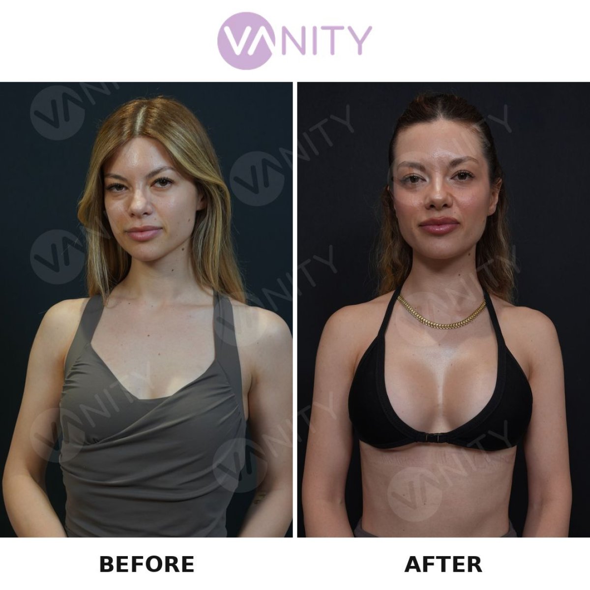 Результаты до и после увеличения груди в Vanity Cosmetic Surgery Center, увеличенный объем