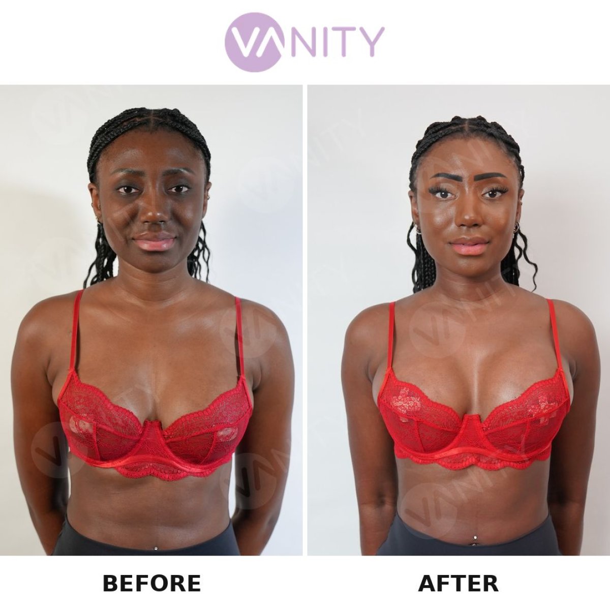 Результаты до и после увеличения груди в Vanity Cosmetic Surgery Center, увеличенный объем