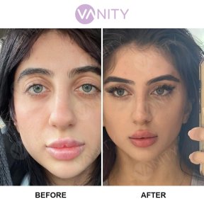 Standard Upper Eyelid Surgery in Vanity Istanbul - photo 5