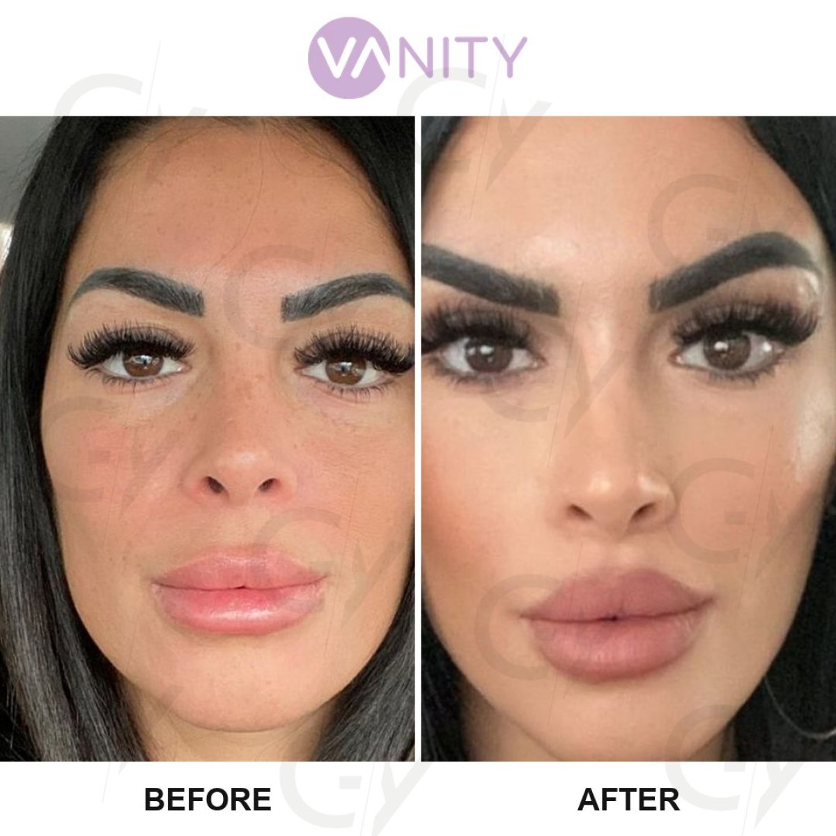 نتائج عملية شد الجفن العلوي قبل وبعد في Vanity Cosmetic Surgery Center