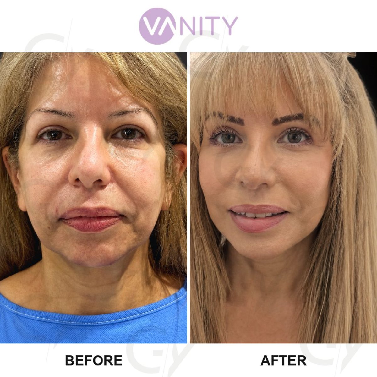 نتائج عملية شد الجفن العلوي قبل وبعد في Vanity Cosmetic Surgery Center، مظهر متجدد