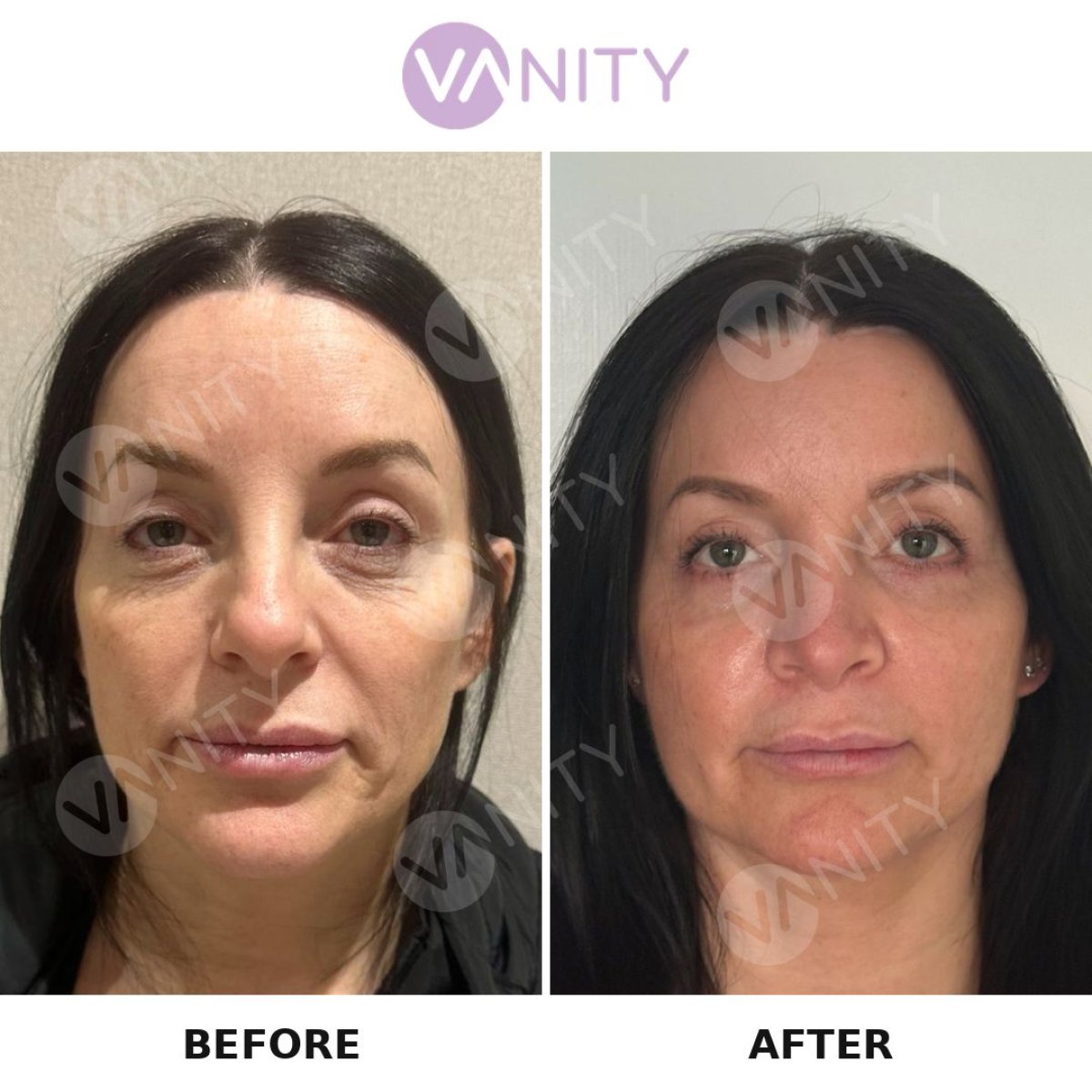 Resultados de blefaroplastia superior antes y después en Vanity Cosmetic Surgery Center