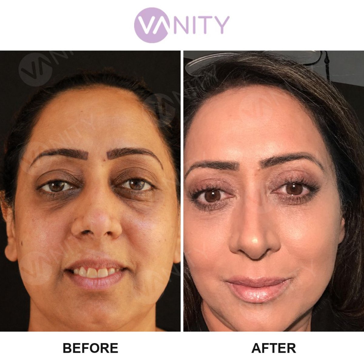 نتائج عملية شد الجفن العلوي قبل وبعد في Vanity Cosmetic Surgery Center، مظهر متجدد
