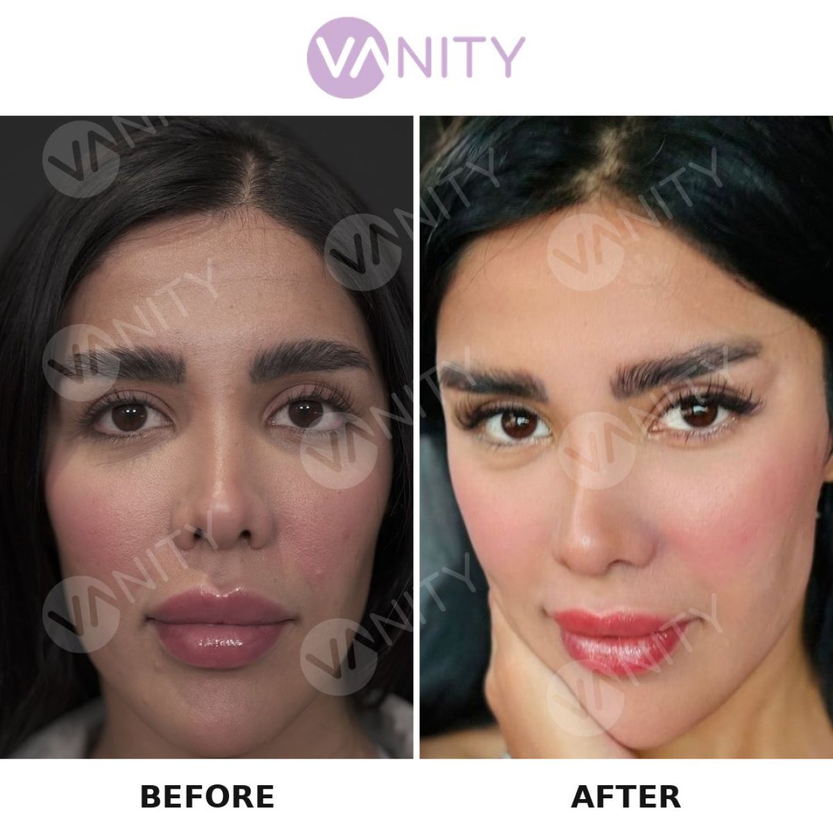 نتائج عملية شد الجفن العلوي قبل وبعد في Vanity Cosmetic Surgery Center، مظهر منعش