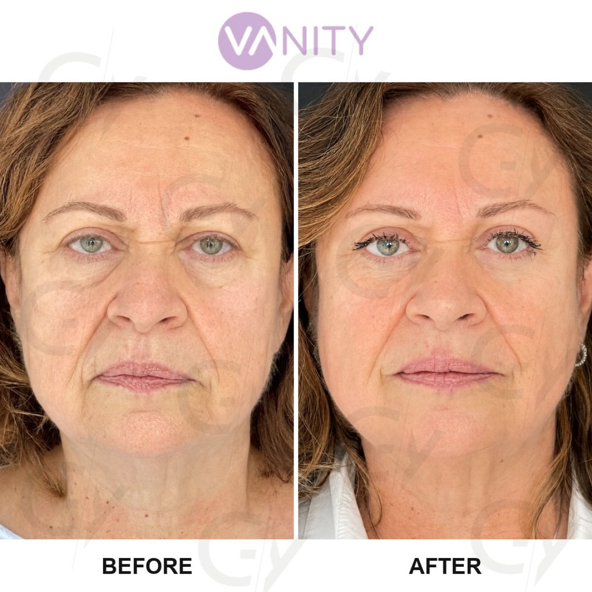 نتائج عملية شد الجفن العلوي قبل وبعد في Vanity Cosmetic Surgery Center، مظهر شبابي