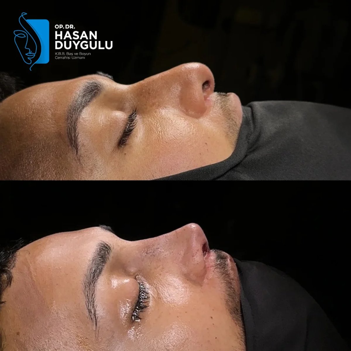 Resultados de septoplastia antes y después en Dr. Hasan Duygulu, perfil nasal mejorado